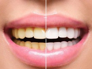 چرا رنگ دندان ها تغییر می کند؟