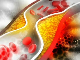 عوامل افزایش کلسترول خون در روزهای آخر سال