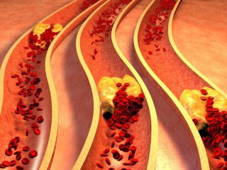 نشانه‌های پنهان کلسترول بالا در خون