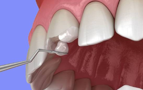 آیا مواد مورد استفاده در باندینگ دندان سرطان زا هستند؟