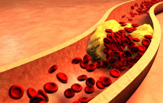6 راهکار اساسی کاهش تری گلیسیرید خون