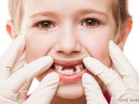 توصیه‌ هایی برای قبل و بعد از کنده شدن دندان شیری