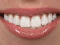 دانستنی های مهم درباره لامینت دندان