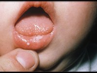 عفونت‌های ویروسی دهان و دندان