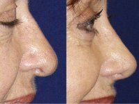 عوارض جراحی زیبایی بینی (2)