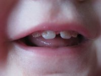 پوسیدگی دندان بیماری شایع