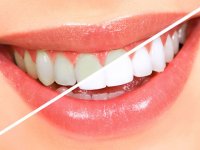روش صحیح سفید كردن دندان (2)