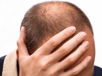 انواع ریزش مو و درمان آن