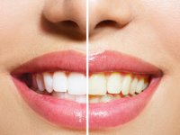 بهترین راهکار برای زیبایی دندان ها