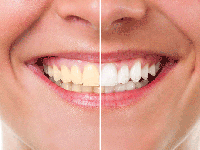 سفید کردن دندان با جدیدترین روش های علمی و سنتی
