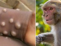 شناسایی ۶ بیمار مشکوک به آبله میمون در ایران