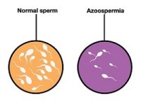 علل و درمان آزواسپرمی یا ناباروری مردان بدون اسپرم
