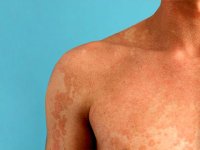 شناخت بیماری پوستی تینا ورسیکالر