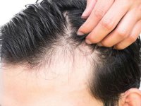 اختلال آلوپسی آندروژنیک کابوسی برای موها