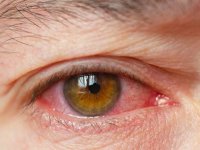 علائم بیماری خشکی چشم چیست ؟