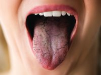 راهکارهای موثر برای درمان خشکی دهان