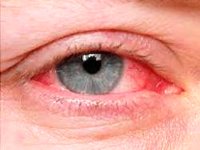 ۶ عفونت چشمی که می‌توانند عواقب خطرناکی داشته باشند
