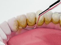 جرم گیری برای دندان ضرر دارد یا خیر؟