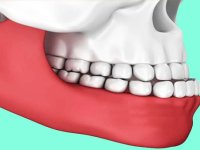 آندربایت دندان و روش‌های درمان قطعی