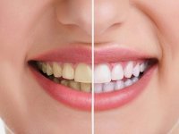 سفید کردن دندان ها به کمک این دهان شویه گیاهی