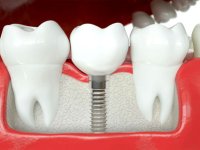 با مراحل ایمپلنت دندان آشنا شوید