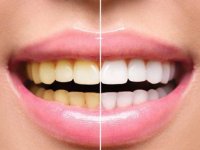 چرا رنگ دندان ها تغییر می کند؟