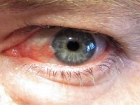 آیا ناخنک چشم راه درمانی دارد؟