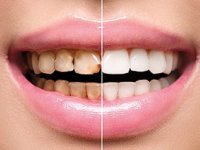 عادت‌های ساده ای که دندان‌های ما را خراب می‌کند