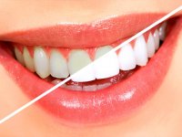 آموزش ساخت محلول معجزه آسا برای جرم گیری دندان